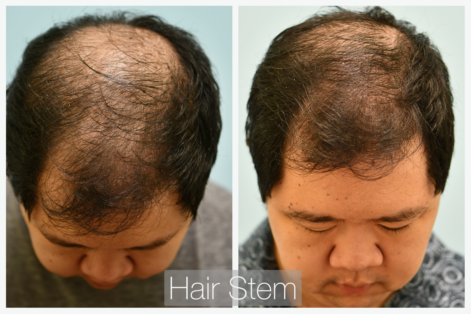 Hair Stem Before & After
