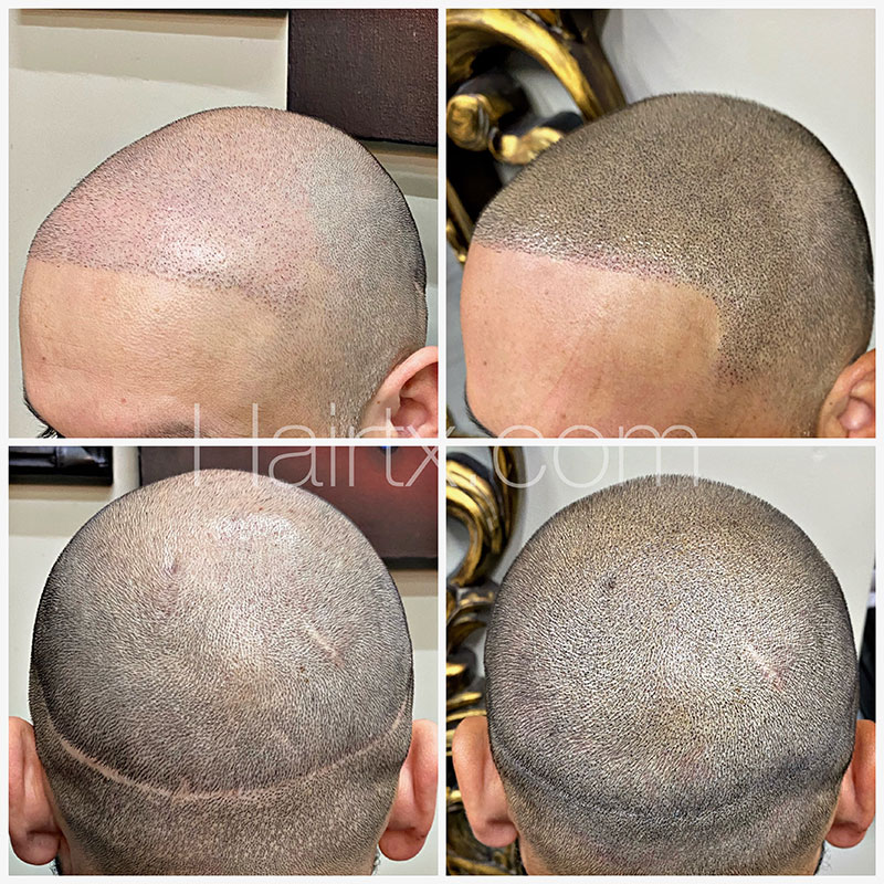 Scalp Micropigmentation (SMP) Before After Photo Dallas