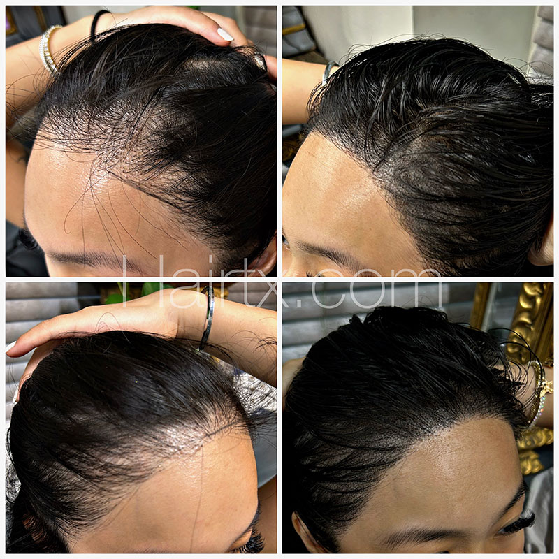 Scalp Micropigmentation (SMP) Before After Photo Dallas