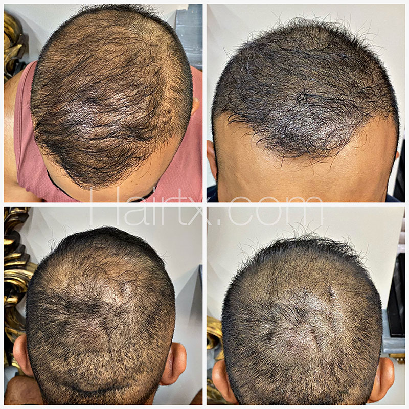 Scalp Micropigmentation (SMP) Before After Photo Dallas