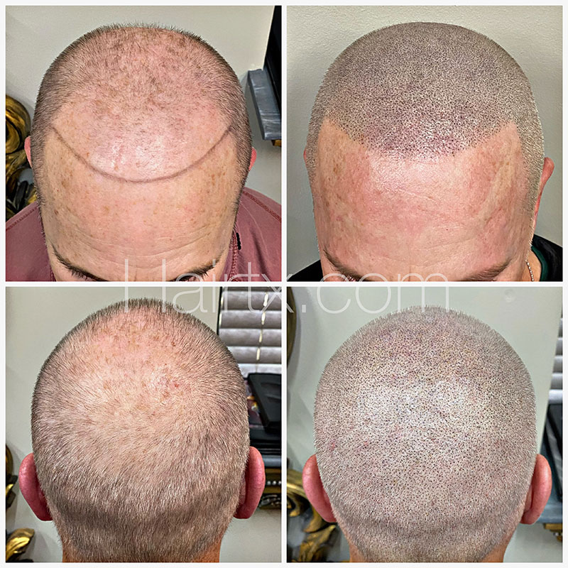 Scalp Micropigmentation (SMP) Before After Photo Dallas