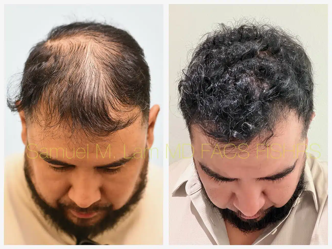 Meso Dutasteride before and after